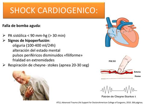 shock cardiogenico-4